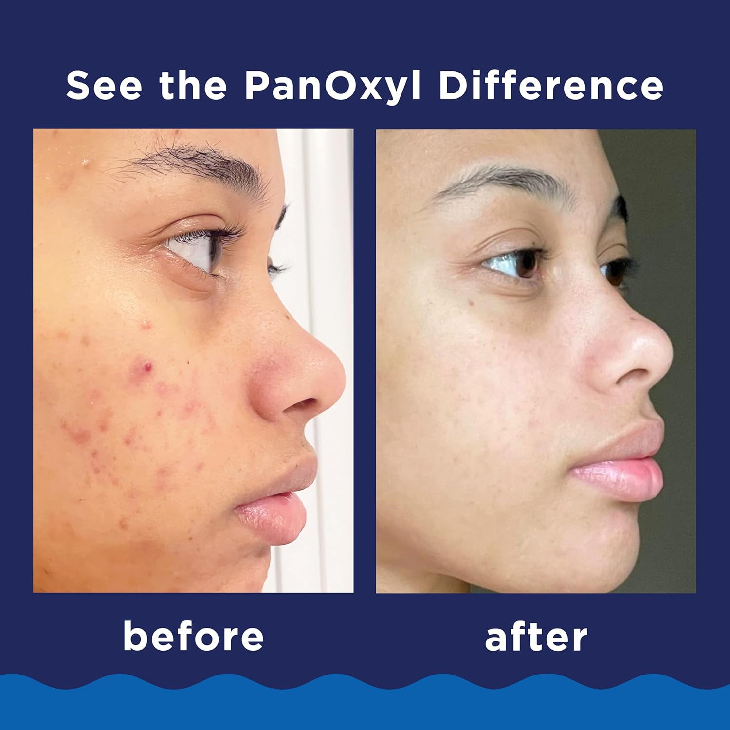 10% Benzoyl Peroxide Acne Foaming Wash